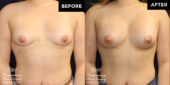 breast augmentation