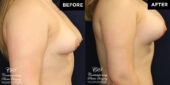 breast augmentation