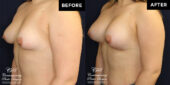 breast augmentation
