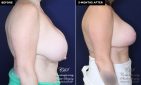 patient 16673's before and after results from a breast implant exchange and breast reduction with a lift at Contemporary Plastic Surgery