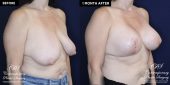 Patient 16673 breast surgery with implants before and after results at Contemporary Plastic Surgery