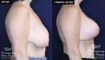 Patient 16673 breast surgery with implants before and after results at Contemporary Plastic Surgery