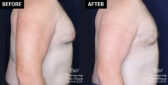 Male breast reduction results at Contemporary Plastic Surgery