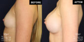 breast augmentation