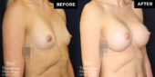 breast augmentation