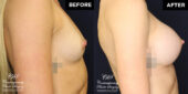 breast augmentation