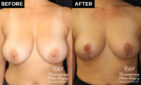 breast reduction and breast lift before and after results at Contemporary Plastic Surgery