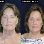 lower face and neck lift with upper eyelid lift before and after results at Contemporary Plastic Surgery