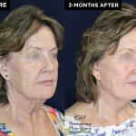 lower face and neck lift with upper eyelid lift before and after results at Contemporary Plastic Surgery