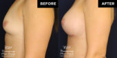 breast augmentation