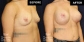 breast augmentation