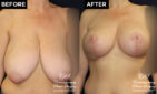 breast reduction and lift before and after results at Contemporary Plastic Surgery