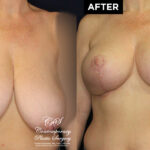 breast reduction and lift before and after results at Contemporary Plastic Surgery