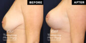 36 y.o woman 3 months following breast reduction of the lower breast, with full breast lift, and placement of round, smooth, extra full projection, soft touch cohesive silicone gel filled implant under muscle for firmness and upper fullness | Patient #17646’s Breast Lift before and after at Jacksonville plastic surgery clinic, Contemporary Plastic Surgery