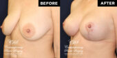 36 y.o woman 3 months following breast reduction of the lower breast, with full breast lift, and placement of round, smooth, extra full projection, soft touch cohesive silicone gel filled implant under muscle for firmness and upper fullness | Patient #17646’s Breast Lift before and after at Jacksonville plastic surgery clinic, Contemporary Plastic Surgery