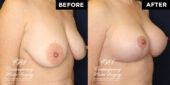 36 y.o woman 3 months following breast reduction of the lower breast, with full breast lift, and placement of round, smooth, extra full projection, soft touch cohesive silicone gel filled implant under muscle for firmness and upper fullness | Patient #17646’s Breast Lift before and after at Jacksonville plastic surgery clinic, Contemporary Plastic Surgery
