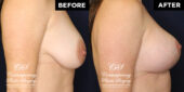 36 y.o woman 3 months following breast reduction of the lower breast, with full breast lift, and placement of round, smooth, extra full projection, soft touch cohesive silicone gel filled implant under muscle for firmness and upper fullness | Patient #17646’s Breast Lift before and after at Jacksonville plastic surgery clinic, Contemporary Plastic Surgery