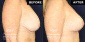 Patient experiencing discomfort from large size and pulling of breasts.  She desired lesser volume and lifting, with a slope to the upper breast. | Patient #17994’s Breast Lift before and after at Jacksonville plastic surgery clinic, Contemporary Plastic Surgery