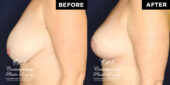 Patient experiencing discomfort from large size and pulling of breasts.  She desired lesser volume and lifting, with a slope to the upper breast. | Patient #17994’s Breast Lift before and after at Jacksonville plastic surgery clinic, Contemporary Plastic Surgery