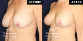 Patient experiencing discomfort from large size and pulling of breasts.  She desired lesser volume and lifting, with a slope to the upper breast. | Patient #17994’s Breast Lift before and after at Jacksonville plastic surgery clinic, Contemporary Plastic Surgery