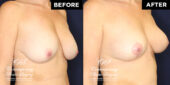 Patient experiencing discomfort from large size and pulling of breasts.  She desired lesser volume and lifting, with a slope to the upper breast. | Patient #17994’s Breast Lift before and after at Jacksonville plastic surgery clinic, Contemporary Plastic Surgery