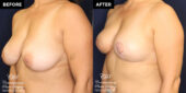 breast reduction surgery