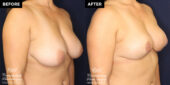 breast reduction surgery