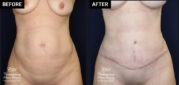 abdominoplasty tummy tuck patient results at Contemporary Plastic Surgery