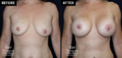 breast augmentation patient results at Contemporary Plastic Surgery