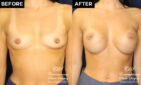 breast augmentation before and after results at Contemporary Plastic Surgery
