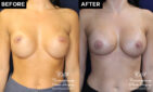 implant pocket tightening before and after results at Contemporary Plastic Surgery
