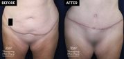 tummy tuck and liposuction patient before and after results at Contemporary Plastic Surgery