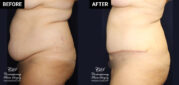 Tummy tuck patient surgery results at Contemporary Plastic Surgery