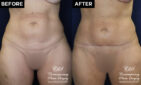 Tummy tuck before and after results at Contemporary Plastic Surgery