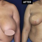 breast reduction patient before and after results at Contemporary Plastic Surgery