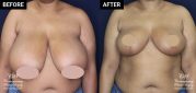 breast reduction patient before and after results at Contemporary Plastic Surgery