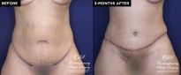 Patient 18489 tummy tuck before and after results at Contemporary Plastic Surgery