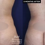 Patient 18489 tummy tuck before and after results at Contemporary Plastic Surgery