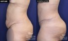 Patient 18489 tummy tuck before and after results at Contemporary Plastic Surgery