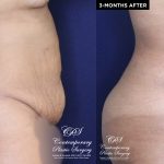 Patient 18489 tummy tuck before and after results at Contemporary Plastic Surgery