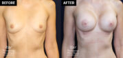 breast augmentation mammoplasty patient results at Contemporary Plastic Surgery