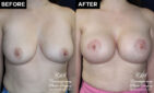 breast augmentation before and after results at Contemporary Plastic Surgery