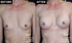 breast implant results at Contemporary Plastic Surgery