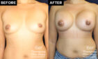breast augmentation patient results at Contemporary Plastic Surgery