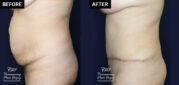 abdominoplasty tummy tuck patient results at Contemporary Plastic Surgery