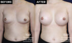 breast augmentation patient results at Contemporary Plastic Surgery
