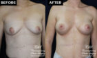 breast augmentation patient results at Contemporary Plastic Surgery