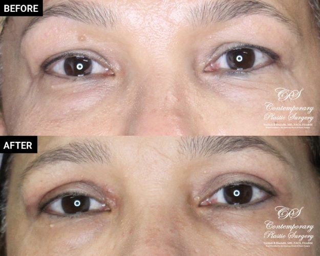 eyelid surgery patient before and after results at Contemporary Plastic Surgery