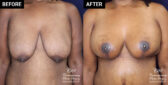 Breast augmentation patient results at Contemporary Plastic Surgery