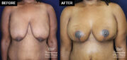 breast augmentation patient results at Contemporary Plastic Surgery